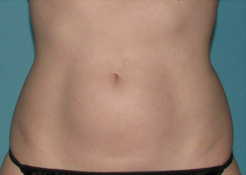 Before CoolSculpting® by Dr. Normand Miller, Salem, NH and Nashua, NH