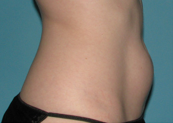 Before CoolSculpting® by Dr. Normand Miller, Salem, NH and Nashua, NH