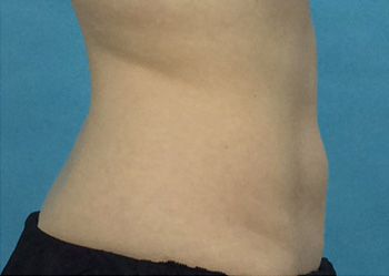 After CoolSculpting® by Dr. Normand Miller, Salem, NH and Nashua, NH