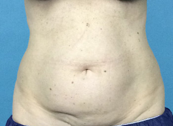 Before CoolSculpting® by Dr. Normand Miller, Salem, NH and Nashua, NH