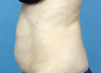 Before CoolSculpting® by Dr. Normand Miller, Salem, NH and Nashua, NH