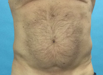 Before CoolSculpting® by Dr. Normand Miller, Salem, NH and Nashua, NH