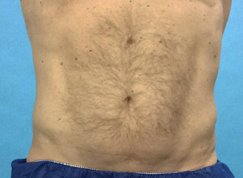 After CoolSculpting® by Dr. Normand Miller, Salem, NH and Nashua, NH