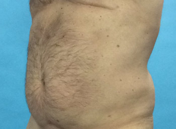 Before CoolSculpting® by Dr. Normand Miller, Salem, NH and Nashua, NH