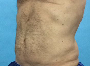 After CoolSculpting® by Dr. Normand Miller, Salem, NH and Nashua, NH