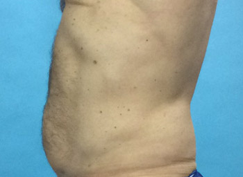 After CoolSculpting® by Dr. Normand Miller, Salem, NH and Nashua, NH