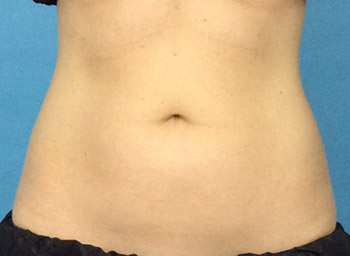 Before CoolSculpting® by Dr. Normand Miller, Salem, NH and Nashua, NH