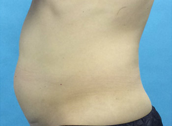 Before CoolSculpting® by Dr. Normand Miller, Salem, NH and Nashua, NH