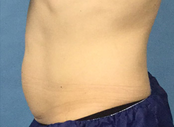 After CoolSculpting® by Dr. Normand Miller, Salem, NH and Nashua, NH