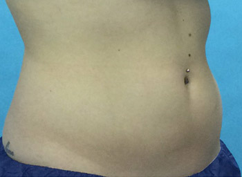 After CoolSculpting® by Dr. Normand Miller, Salem, NH and Nashua, NH