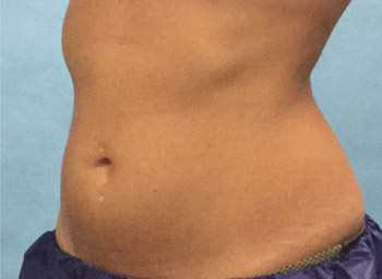 After CoolSculpting® by Dr. Normand Miller, Salem, NH and Nashua, NH