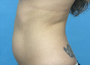 Before CoolSculpting® by Dr. Normand Miller, Salem, NH and Nashua, NH