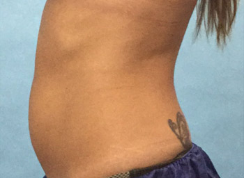 After CoolSculpting® by Dr. Normand Miller, Salem, NH and Nashua, NH