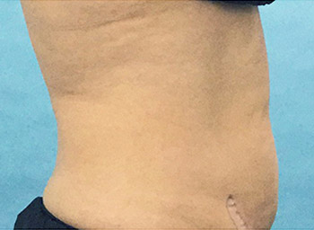 After CoolSculpting® by Dr. Normand Miller, Salem, NH and Nashua, NH