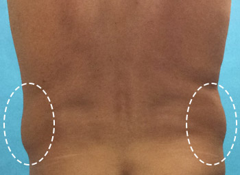 Before CoolSculpting® by Dr. Normand Miller, Salem, NH and Nashua, NH