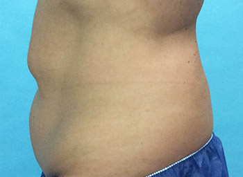 Before CoolSculpting® by Dr. Normand Miller, Salem, NH and Nashua, NH