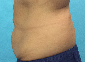 After CoolSculpting® by Dr. Normand Miller, Salem, NH and Nashua, NH