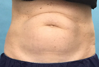 Before CoolSculpting® by Dr. Normand Miller, Salem, NH and Nashua, NH