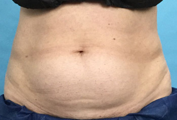 Before CoolSculpting® by Dr. Normand Miller, Salem, NH and Nashua, NH