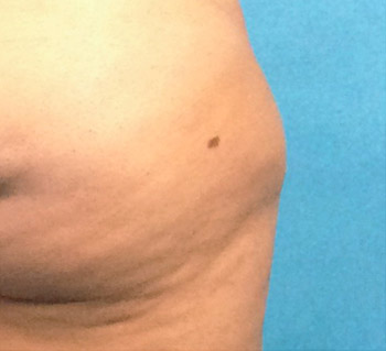 After CoolSculpting® by Dr. Normand Miller, Salem, NH and Nashua, NH