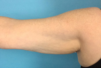After CoolSculpting® by Dr. Normand Miller, Salem, NH and Nashua, NH