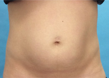 Before CoolSculpting® by Dr. Normand Miller, Salem, NH and Nashua, NH