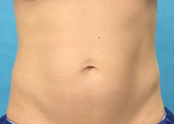 Before CoolSculpting® by Dr. Normand Miller, Salem, NH and Nashua, NH