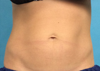 After CoolSculpting® by Dr. Normand Miller, Salem, NH and Nashua, NH