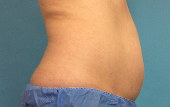 Before CoolSculpting® by Dr. Normand Miller, Salem, NH and Nashua, NH