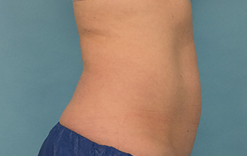 After CoolSculpting® by Dr. Normand Miller, Salem, NH and Nashua, NH