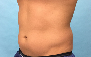 Coolsculpting® Before and After Photos  NH