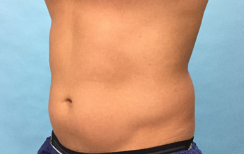 Before CoolSculpting® by Dr. Normand Miller, Salem, NH and Nashua, NH