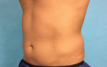 Coolsculpting® Treatment Before & After NH