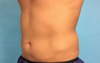 After CoolSculpting® by Dr. Normand Miller, Salem, NH and Nashua, NH