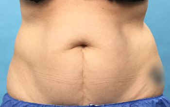 Before CoolSculpting® by Dr. Normand Miller, Salem, NH and Nashua, NH