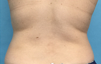 After CoolSculpting® by Dr. Normand Miller, Salem, NH and Nashua, NH