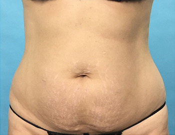 Before CoolSculpting® by Dr. Normand Miller, Salem, NH and Nashua, NH