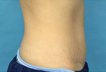 After CoolSculpting® by Dr. Normand Miller, Salem, NH and Nashua, NH