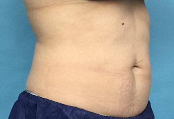 After CoolSculpting® by Dr. Normand Miller, Salem, NH and Nashua, NH