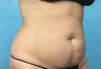 Before CoolSculpting® by Dr. Normand Miller, Salem, NH and Nashua, NH