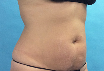 After CoolSculpting® by Dr. Normand Miller, Salem, NH and Nashua, NH