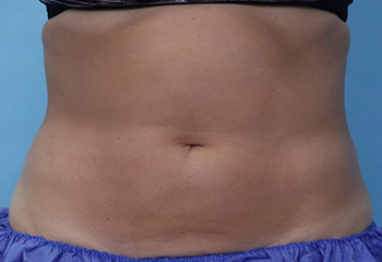 After CoolSculpting® by Dr. Normand Miller, Salem, NH and Nashua, NH