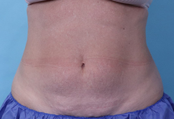 After CoolSculpting® by Dr. Normand Miller, Salem, NH and Nashua, NH