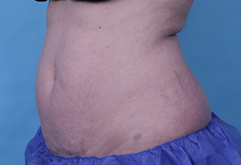 Before CoolSculpting® by Dr. Normand Miller, Salem, NH and Nashua, NH