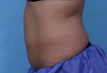 After CoolSculpting® by Dr. Normand Miller, Salem, NH and Nashua, NH