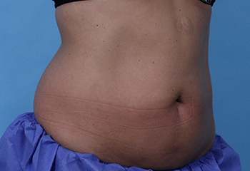 After CoolSculpting® by Dr. Normand Miller, Salem, NH and Nashua, NH