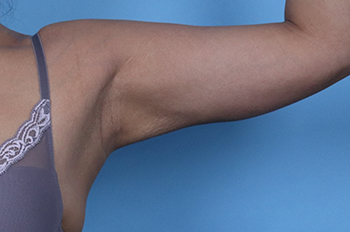 After CoolSculpting® by Dr. Normand Miller, Salem, NH and Nashua, NH