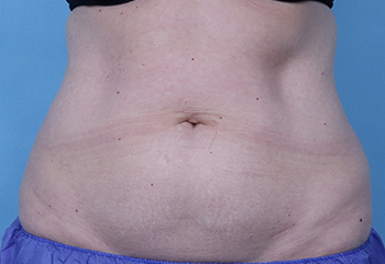 Before CoolSculpting® by Dr. Normand Miller, Salem, NH and Nashua, NH