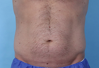 Before CoolSculpting® by Dr. Normand Miller, Salem, NH and Nashua, NH