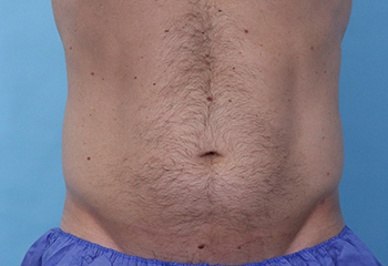 After CoolSculpting® by Dr. Normand Miller, Salem, NH and Nashua, NH